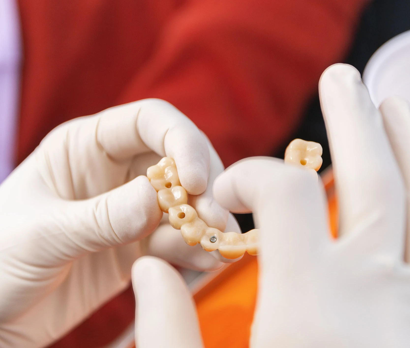 Implantes dentales Carillas dentales en clinica dental en Málaga