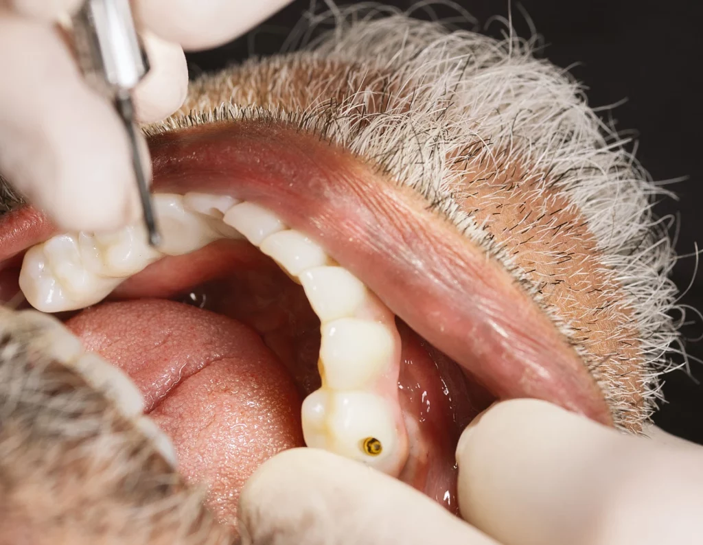 Implantes dentales de carga inmediata