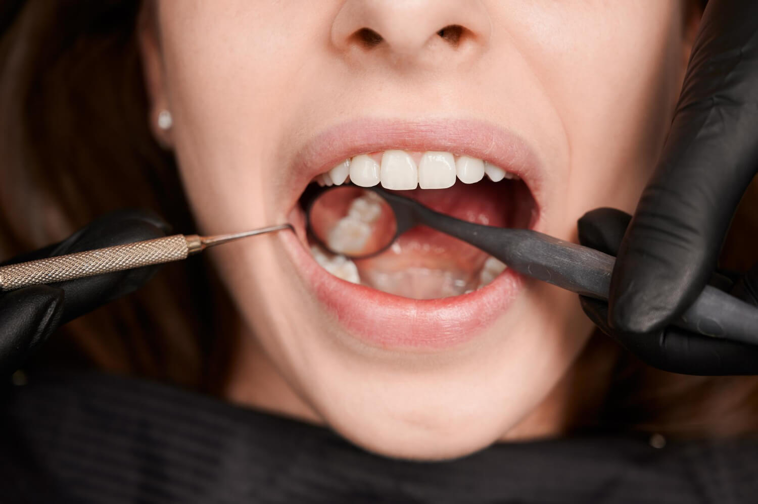 extracciones dentales que son